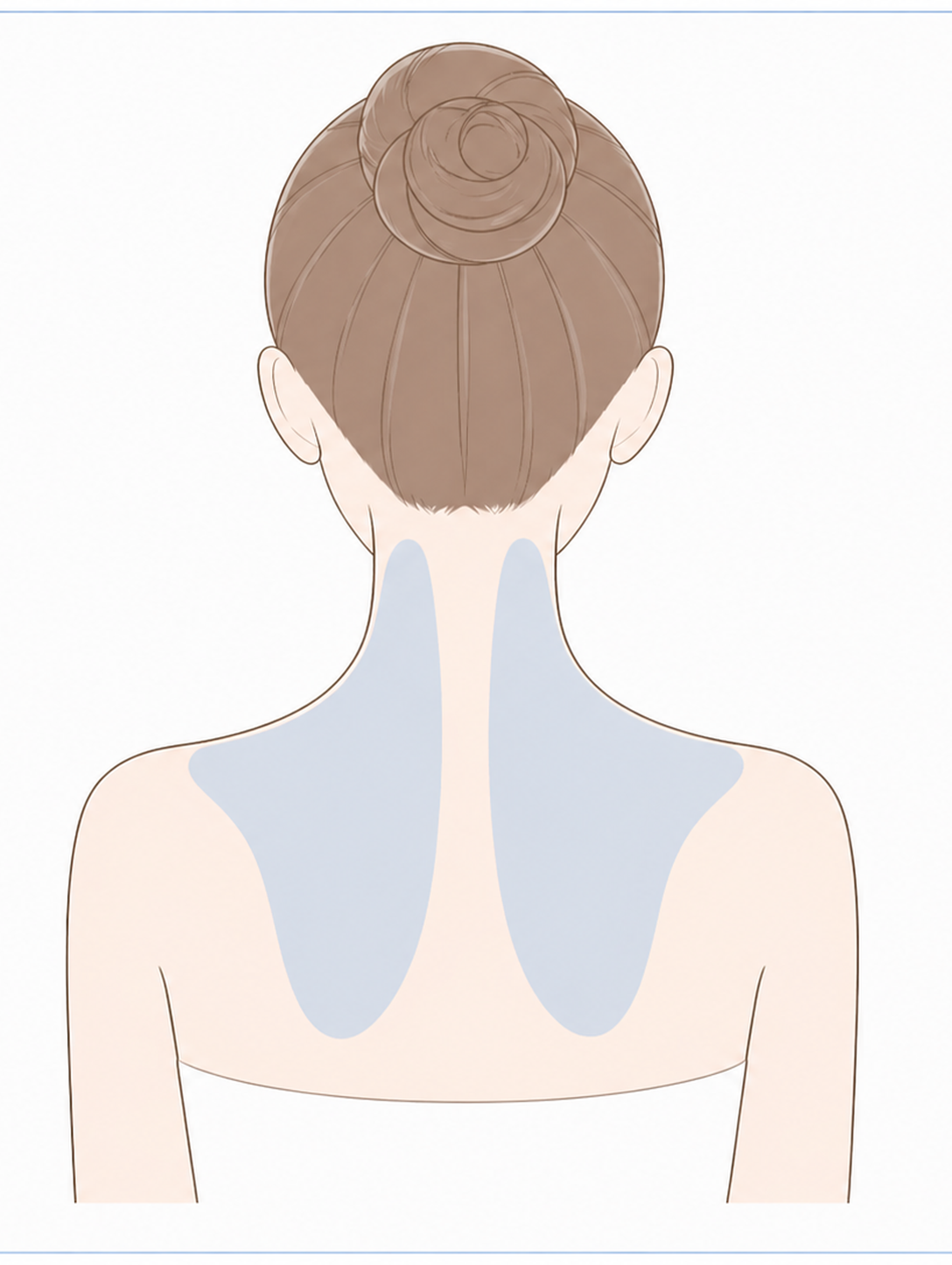 肩ボトックス（僧帽筋）の施術部位イラスト